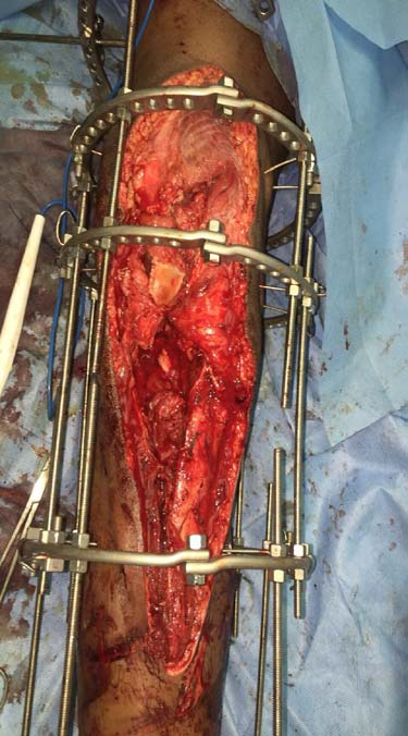 Fig. 16: Showing 18 month post-op x-ray right knee and leg AP and lateral views.