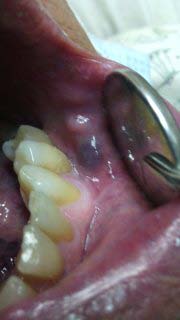Figure-2: Perichondritis due to assault.