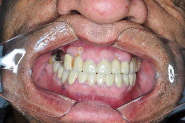 Figure-5: Auricular cellulitis with Hematoma.