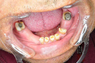 Figure-6: Cellulitis of pinna due to Furunculosis.