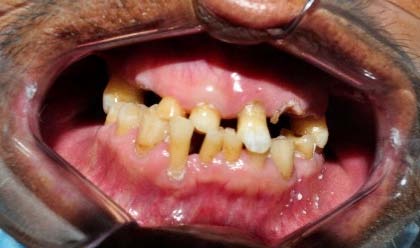 Figure-10: Perichondritis due to accident.