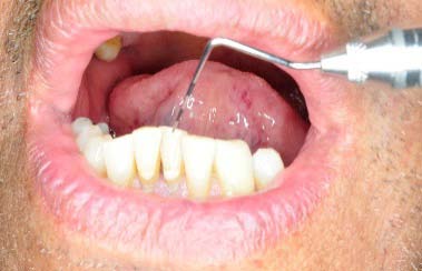 Figure-11: Helical incision along the margin of the helix of pinna.