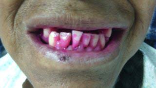 Figure-12: Button placed medial and lateral side of bivalve pinna and fixed by thred 3/0 proline.