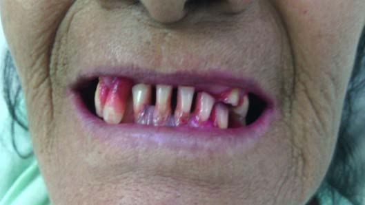 Figure-13: Fix the bivalve pinna of a teenage girl by button method.