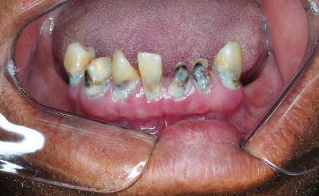 Figure-15: n-63; 1. Gender: Female-30: Male-33, 2. Age: Children-27: Adult-36, 3. Personal history: Diabetic-8: Smoker-9, 4. Presenting features: Earache-61: Red, Hot & Stiff pinna-59: Abscess-36, 5. Bacteriology: Pseudomonas-21: Staphylococcus-15: Streptococcus-13: Gram Negative-11.