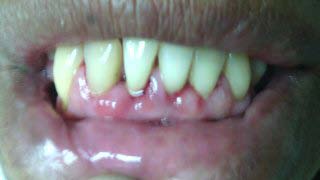 Literature Review: Oral Rehabilitation in Patients Up To 16 Years Old with Hypohidrotic Ectodermal Dysplasia (HED)