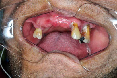 Figura 9: Porcentaje de casos de enfermedad periodontal Cuadro 2: Movilidad Dental
