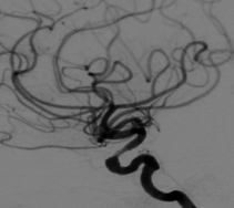 occluded RT. ICA, <50% stenosis of the RT. MCA and the Basilar A. B. >50% stenosis of the RT. ICA and totally occluded RT. MCA.