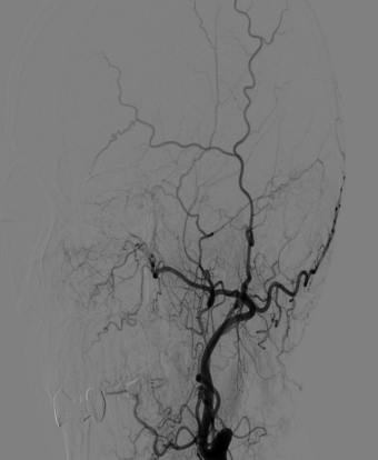 Figure 2: Intracranial large vessel stenosis and occlusion by TOF MRA (Collapsed image) of the Ant. and Post. Circulations IV.