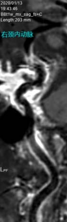 Stroke Subtypes and Intracranial Large Vessel Stenosis Clinical and Radiological Profile