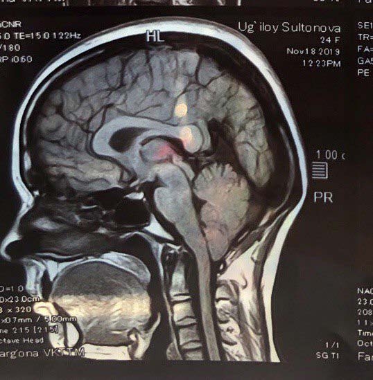 Figure 1: An example of MRI of patient S., with Chiari malformation of type 1 with ectopia of cerebellar tonsils 14mm on the right and 12mm on the left