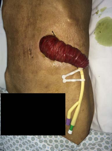 Fig.2: Alça jejunal com múltiplas perfurações (setas brancas) identificadas no intra-operatório