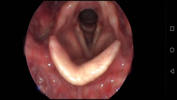 Figure-5: Supraglottic huge growth.