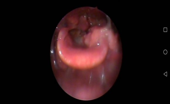 Figure-7: Vocal cord nodule.