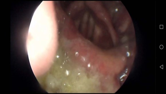 Figure-8: Functional dysphonia.