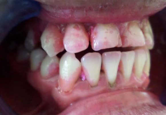 Protocol with guidelines for dental care after the COVID-19 pandemicThe importance of Minimal Intervention Dentistry after the COVID-19 pandemic: A look to the future