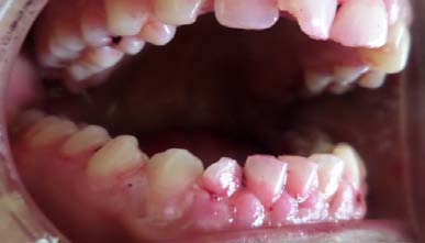 Figure 1: Preoperative radiograph Figure 2: Working length radiograph