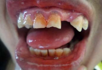 Figure 11: Canal Obturated With MTA