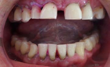 Figura 4: Resultados de evaluación periodontal, A) Porcentaje de casos de enfermedad periodontal B)Porcentaje de Extensión de la Enfermedad Periodontal