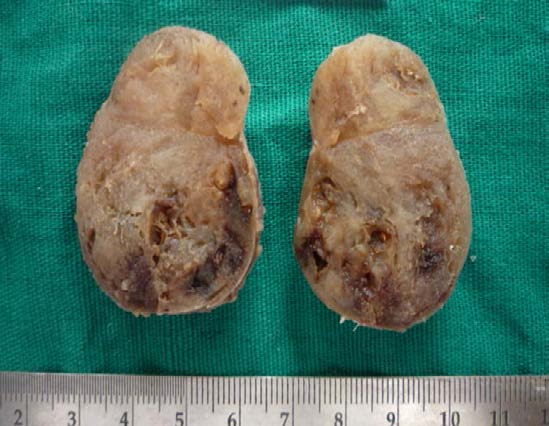 Figure 1: Clinical image: Extra-oral cervical swelling of about 3x2 cm, evident in the submandibular region about 4 cm below the inferior border of the mandible