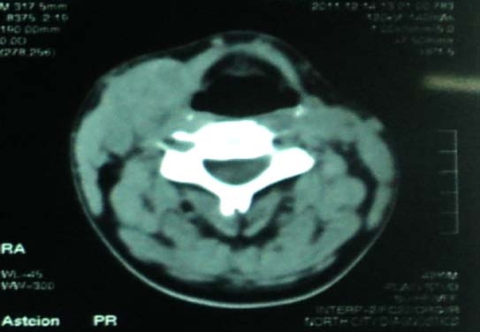 Figure 3: Figure 3: Photomicrographs of H&E stained tissues exhibit: 3A-Encapsulated lymph node tissue with peripherally situated lymphoid follicles and centrally numerous follicles filled with eosinophilic colloidal material (x40). 3B: Epithelium lining the follicles is thrown into papillary growths (x40). 3C: Follicles are lined by single layer of secretory epithelial cells exhibiting focal nuclear crowding. Edges of the follicle exhibit scalloping of eosinophilic coagulum (x100). 3D: Dysplastic secretory epithelial cells with large open face nuclei, nuclear clearing and minimal stroma (x200).
