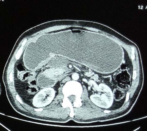 Post-Traumatic Duodenal Stenosis following a Duodenal Hematoma: Case Report and Review of the Literature