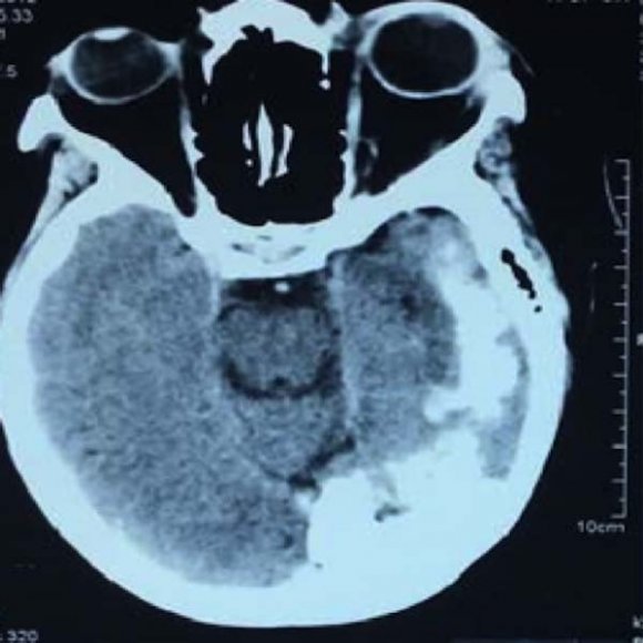 Figure 4: Calcifications on the Left parietal and occipital cerebral hemispheres