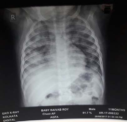 Fig. 1: X ray showing bilateral infiltrates.
