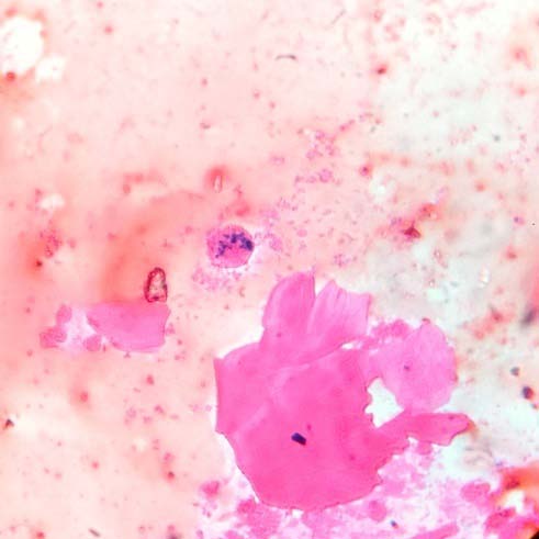 Fig. 2(A, B): Perl's Prussian blue stain showing hemosiderin pigment.