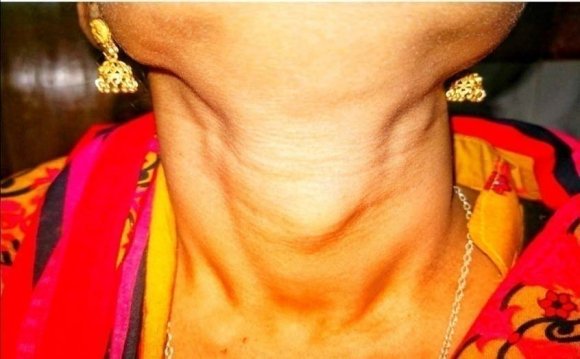 Spongstan with Nasopharyngeal Pack: New Ordinary Procedure Manage the Adenoidectomy Bleeding