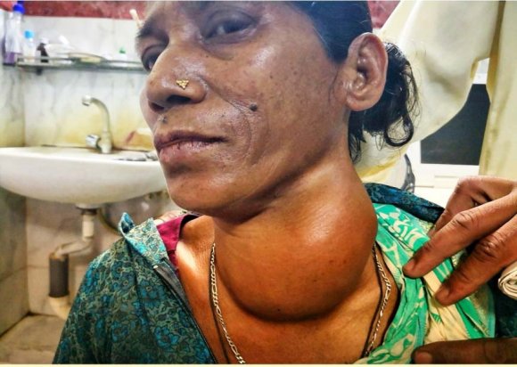 Figure-2: Usually used as a postnasal pack, twisted portion in nasopharynx and free portion anchored on cheek by micropore surgical tape.