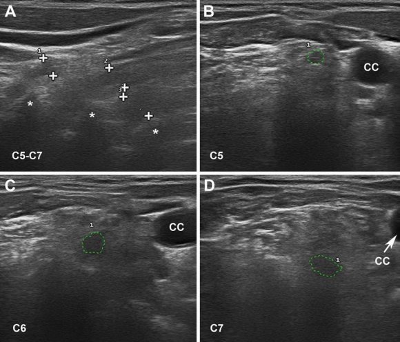Fig. 1: US of ventral rami of C5-C7 nerves in early AIDP. Taken from reference [33]. a Sagittal sonogram showing blurred boundaries of the 3 scanned cervical nerves (callipers). Asterisks indicate transverse vertebral processes. b-d Short-axis sonograms showing the cross sectional areas of each cervical nerve(dotted green tracings), whose values are as follows: C5 = 9 mm 2 (control mean 6.22; SD 2.75), C6 = 18 mm 2 (control mean 9.63; SD 4.21) and C7 = 23 mm 2 (control mean 12.29; SD 5.33). CC indicates common carotid artery