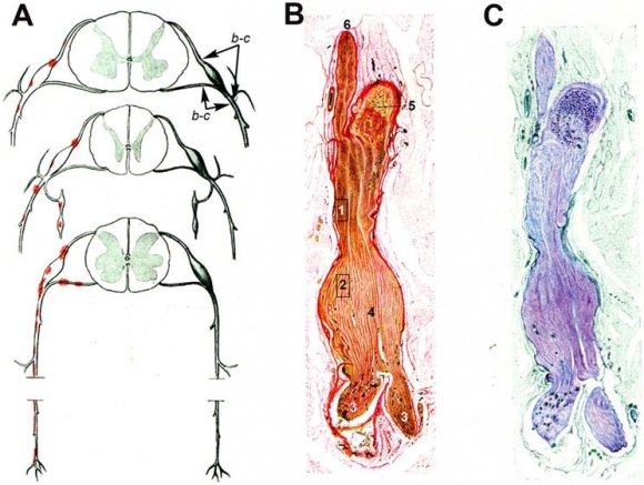 Fig. 2: Pathology of GBS. Adapted from Figs. 65 to 67 by Krücke [40] with minimal modifications. a Diagram of GBS lesions at cervical (upper row), thoracic (middle row) and sacral (lower row) levels; note that they mainly rely on proximal nerves including ventral and dorsal spinal roots, spinal root ganglia, sympathetic ganglia and ventral rami of spinal nerves (red dots). Lettering b-c indicates nerve segment illustrated in the following two images. b Longitudinal section of the nerve segment between anterior spinal root and spinal nerve from a GBS patient who died on day 18, original numbering being as follows: (1 and 2) areas illustrated by the author in other figures (specially his Fig. 68b showing abundant endoneurial inflammatory oedema, which was designated as "mucoid exudate"); (3) rami of the spinal nerve (undoubtedly, ventral and dorsal rami); (4) splinded shaped swelling of the spinal nerve; (5) spinal root ganglion; and (6) anterior spinal root (Van Gieson, magnification not specified). c The same longitudinal section showing a purplish discoloration of the spindle-shaped swelling of the spinal nerve (Cresyl violet, magnification not specified)