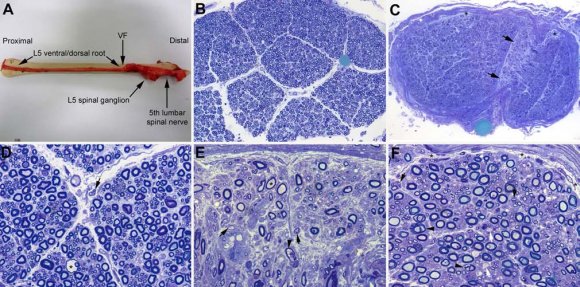 Fig. 4: Composite image to compare lesions in anterior spinal roots. Taken from Fig. 3 by Berciano et al. [34] (a) and Fig. 2 by Feasby et al. [47] (b). Both pictures correspond to transverse semithin sections of ventral lumbar roots. a Keeping up original graphic resources, note the presence of numerous endoneurial lipid-laden macrophages, sometimes encircling degenerated fibres with myelin collapse (white asterisks). There are clusters of regeneration containing either non-myelinated axons (arrowheads) or non-myelinated and thinly myelinated axons (small arrows), and also occasional demyelinated or remyelinated axons (large arrows). Black asterisk indicates a fiber exhibiting vesiculo-vacuolar dissolution of myelin (Toluidine blue; bar = 19 ?m). bThe original figure legend, with no graphic resources, is as follows: "Transverse section showing severe axonal degeneration". My interpretation is keeping with this criterion, as there are numerous fibers showing myelin collapse (white asterisks), which is indicative of acute axonal degeneration[13,14]. But note also the presence of fibres with inappropriately thin myelin sheaths (arrowheads) and frequent fibres exhibiting vesiculo-vacuolar dissolution of myelin (large arrows), both features suggesting primary demyelination. In my view, there are frequent endoneurial ovoid or reniform nuclei (small arrows), which most probably correspond to macrophages (Toluidine blue; bar = 20 ?m). (Reproduced with permission from Brain, Oxford University Press)