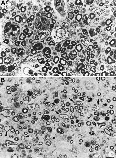 Fig. 5: Ischemic nerve lesions in AIDP. Adapted from Berciano et al. [69]. Semithin sections of the ventral ramus of the third lumbar nerve (a) and lumbosacral trunk (b) illustrating wedge-shaped and centrofascicular areas with marked loss of myelinated fibres (arrows) (Toluidine blue; original magnification × 62 before reduction). c This semithin section of the central region of the lumbosacral trunk illustrates severe reduction of large myelinated fibres, thinly myelinated small axons, preserved unmyelinated axons (arrowheads), and endoneurial mononuclear cells and lymphocytes (arrows) (Toluidine blue; original magnification 470 before reduction). d This semithin section of the subperineurial area of the lumbosacral trunk shows numerous thinly myelinated fibres and occasional mononuclear cells; such extensive de-remyelination accounts, to some degree, for the apparent widespread loss of myelinated fibres perceptible in image B (Toluidine blue; original magnification × 375 before reduction)