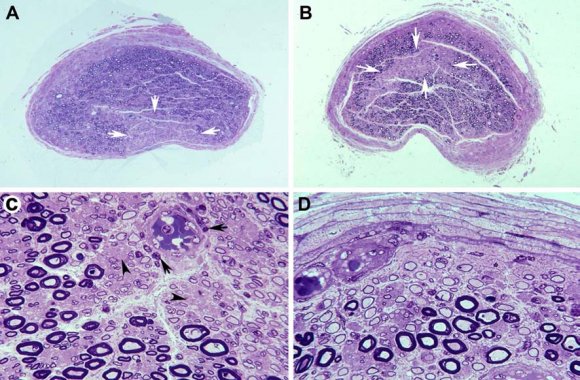 Fig.6: Axonal repair in AIDP. Adapted from Berciano et al.[69]. a This semithin section of L5 ventral root shows that the density of myelinated fibres is preserved, although there are thinly myelinated fibres and fibres with vacuolated myelin (arrows) (Toluidine blue; original magnification ×375 before reduction). b This semithin section of L5 dorsal root illustrates three dark fibres (arrows) (Toluidine blue; original magnification ×750 before reduction). c This electron micrograph shows the morphology of a dark fibre characterized by an attenuated axon (arrow) surrounded by complex adaxonal Schwann cell processes and normal myelin (×5900 before reduction). d This longitudinal electron micrograph section shows extensive accumulation of vacuoles, degenerated organelles, and amorphous material in the adaxonal Schwann cell cytoplasm. Such accumulation is more pronounced in the paranodal regions (asterisks), though involving the internodal regions. Note that the axon is variably displaced but otherwise preserved (×2200 before reduction)