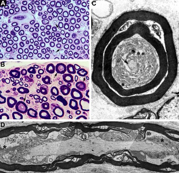 Axonal Degeneration in Guillain-Barré Syndrome: A Reappraisal