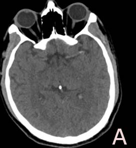 Figure 1A: Plain CT scan showed subtle hyperdensity in the left MCA Figure 1b and 1c: CT perfusion revealed CBF and CBV apparent mismatch in the left cerebral hemisphere, mainly in the left frontoparietal region in the territory of the left MCA IV Thrombolysis was initiated as per protocol with a bolus of Alteplase 6.3 mg, followed by an infusion of 56.7 mg. A neuro-interventionist was involved, and the patient underwent mechanical thrombectomy. Simultaneously, as per Qatar CDC guidelines, he was started on Azithromycin, Hydroxychloroquine, and Oseltamivir combination as part of his Covid-19 treatment based on worsened chest X-ray, after ensuring the QTC is below 450 on ECG in such patients. A filling defect (floating thrombus) noted in the distal left CCA before bifurcation. Total occlusion of the Left ICA and MCA by a large thrombus load starting from the distal cavernous segment. Aspiration thrombectomy; which cleared up the floating thrombus using Solumbra technique (combined aspiration and mechanical thrombectomy) using Solitaire 6X40mm stent; two trials were made and cleared up the ICA and MCA with a final control angiogram revealing adequate recanalization TICI 3. 10 mg Verapamil was injected to overcome spasm in the Left ICA and Left M1 segment. The clots recovered were sticky and soft, suggestive of the embolic source. The intracranial vessels did not show any atherosclerotic features, and there is no evidence of carotid dissection. (Figure 2a, 2b and 2c).