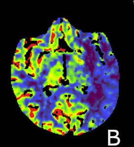 Figure: 2a showing a floating thrombus in the left CCA Figure: 2b, and 2c show DSA Pre and Post Thrombectomy.