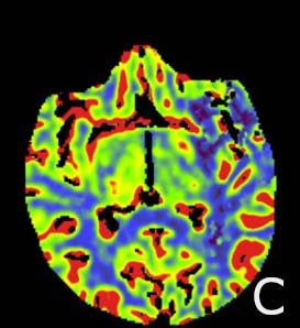 Figure 3: CTA done post thrombectomy reconfirming the recurrence of the thrombus in the Left ICA, MCA.