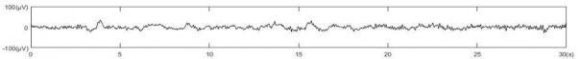 54. Cooper DM, Yu EZ, Hennessey P, Ko F, Robson MC. Determination of endogenous cytokines in chronic wounds. Ann. Surg. 1994; 219:688-691.