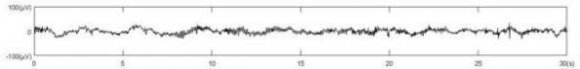 Learning for Classification of Sleep EEG Data during the Epidemic of Coronavirus Disease Mingzhe E ? , Jinming Cao ? & Bin Zhao ? Abstract-Sleep is an important part of the body's recuperation and energy accumulation, and the quality of sleep also has a significant impact on people's physical and mental state during the epidemic of Coronavirus Disease. It has attracted increasing attention on how to improve the quality of sleep and reduce the impact of sleep-related diseases on health during the Epidemic of Coronavirus Disease. The electroencephalogram (EEG) signals collected during sleep belong to spontaneous EEG signals. Spontaneous sleep EEG signals can reflect the body's changes, which is also an basis for diagnosis and treatment of related diseases. Therefore, the establishment of an effective model for classifying sleep EEG signals is an important auxiliary tool for evaluating sleep quality, diagnosing and treating sleep-related diseases.