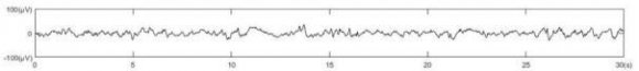 Figure 1 shows the time series of EEG signals corresponding to different sleep stages, from top to bottom, namely, wakefulness, sleep I, sleep II, deep sleep and REM.Figure1shows the characteristics of EEG signals vary in different sleep stages during the epidemic of Coronavirus Disease.