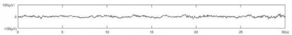 Figure 1: The sequence of sleep EEG signals in sleep stages. Automatic staging based on EEG signals can reduce the artificial burden on expert physicians and it is a useful auxiliary tool for assessing sleep quality, diagnosing and treating sleep-related diseases. In this paper, Python is used to build a neural network, and design a sleep staging prediction model. Based on as few training samples as possible, it can obtain relatively high prediction accuracy. II.