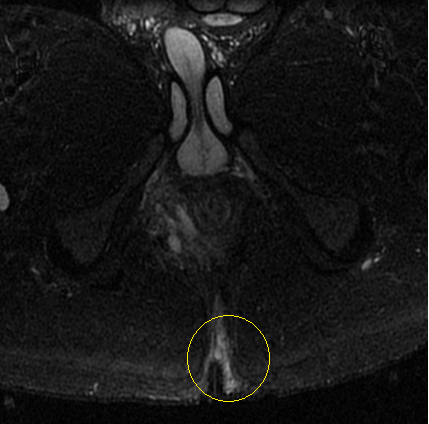 MRI will show loculated T2W and STIR hyperintense pockets of collection with mild post contrast rim enhancement. This correlates to Stage 1 of clinical classification. (Refer figure A) This may either heal by mild scarring or progress towards chronic skin involvement in the form of multiple raised subdermal pockets of pus which ultimately rupture to form sinus tract. (Refer figure B) This correlates to Stage 2 of clinical classification. The stage 3 of clinical classification is includes extensive local involvement in terms of area as well as severity and often includes refractory cases with multiple interconnecting sinus tracts. The chronicity can be identified by thick walls of the sinus tract appearing hypointense on STIR due to scarring.(Refer figure C)