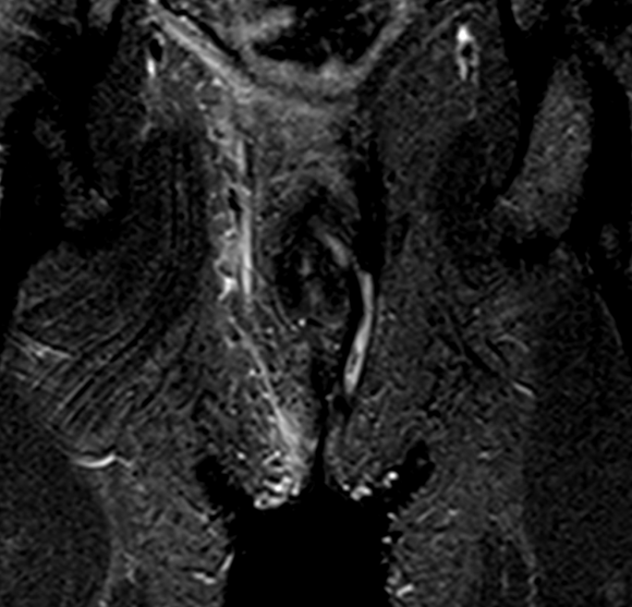 Figure B: Hurley Stage 2 MRI of the perineum: Coronal STIR image shows evolution of the abscess into a linear hyperintense tract/ sinus formation.