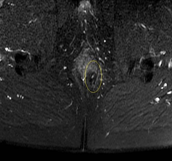 Figure C: Hurley Stage 3.MRI of the perineum:Coronal STIR image from the selected slices shows evolution of the abscess into a linear hyperintense tract/ sinus formation. Due to chronicity of the sinus, the tract appears more fibrosed and hypointense.