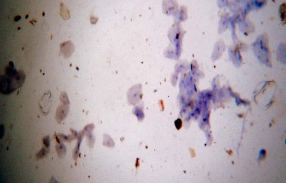 Fig. 6: Copper Sulphate Dipped smear