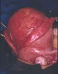 Introduce Optics from the Cervix Towards the Uterine Fundus in Hysteroscopy During the Exploration Correct: Always Vision from the Fundus towards the External Part 51. Releasing uterine synechiae. Uterine synechiae