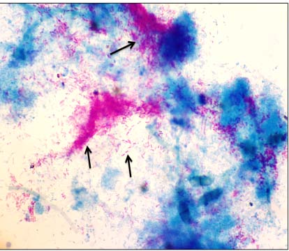 Figure 1: Research ProceduresThe study used medical records from patients diagnosed with EPTB. The study used characteristics associated with the degree of tissue biopsy preparations stained with the Ziehl Neelsen Acid Fast Bacillus (AFB) method positivity, clinical symptoms of patients, both localized and systemic. It also recorded patients with histopathological diagnosis of infection (using Hematoxylin-eosin staining) and with process-specific infection of EPTB. The analysis results used in collaboration with the TB scoring method that previously existed used to develop our scoring system. The study received approval from the Ethics Committee of Medical Faculty UNISBA No. 362 / Ethics Committee.FK/XII/2017The first step in this study was reviewing a contingency table provided by the previous study to see AFB's clinical manifestations and the histopathological
